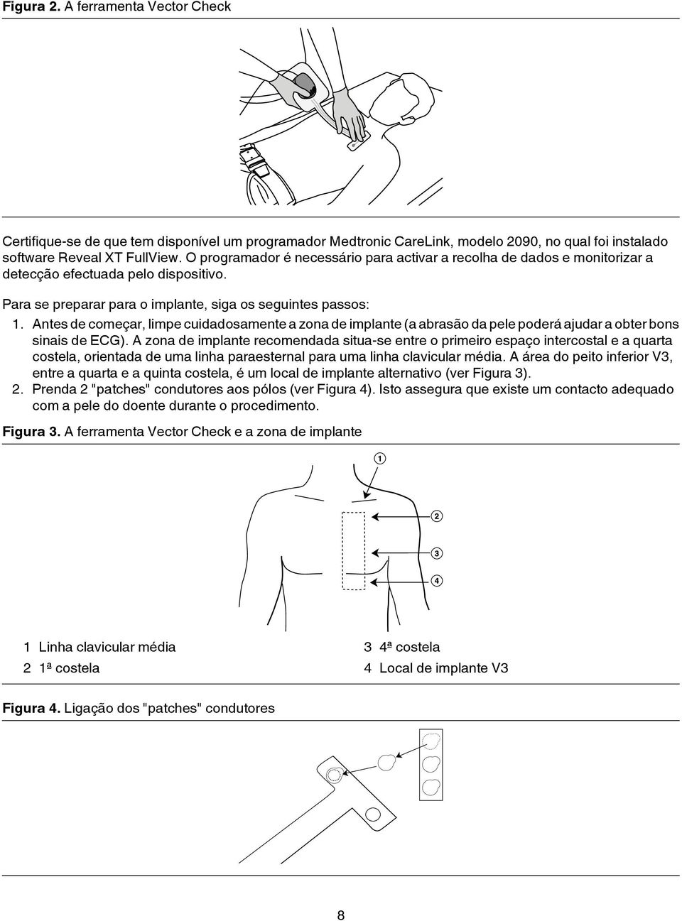 Antes de começar, limpe cuidadosamente a zona de implante (a abrasão da pele poderá ajudar a obter bons sinais de ECG).