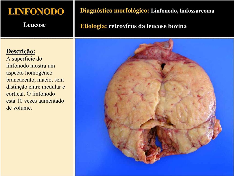 linfonodo mostra um aspecto homogêneo brancacento, macio, sem