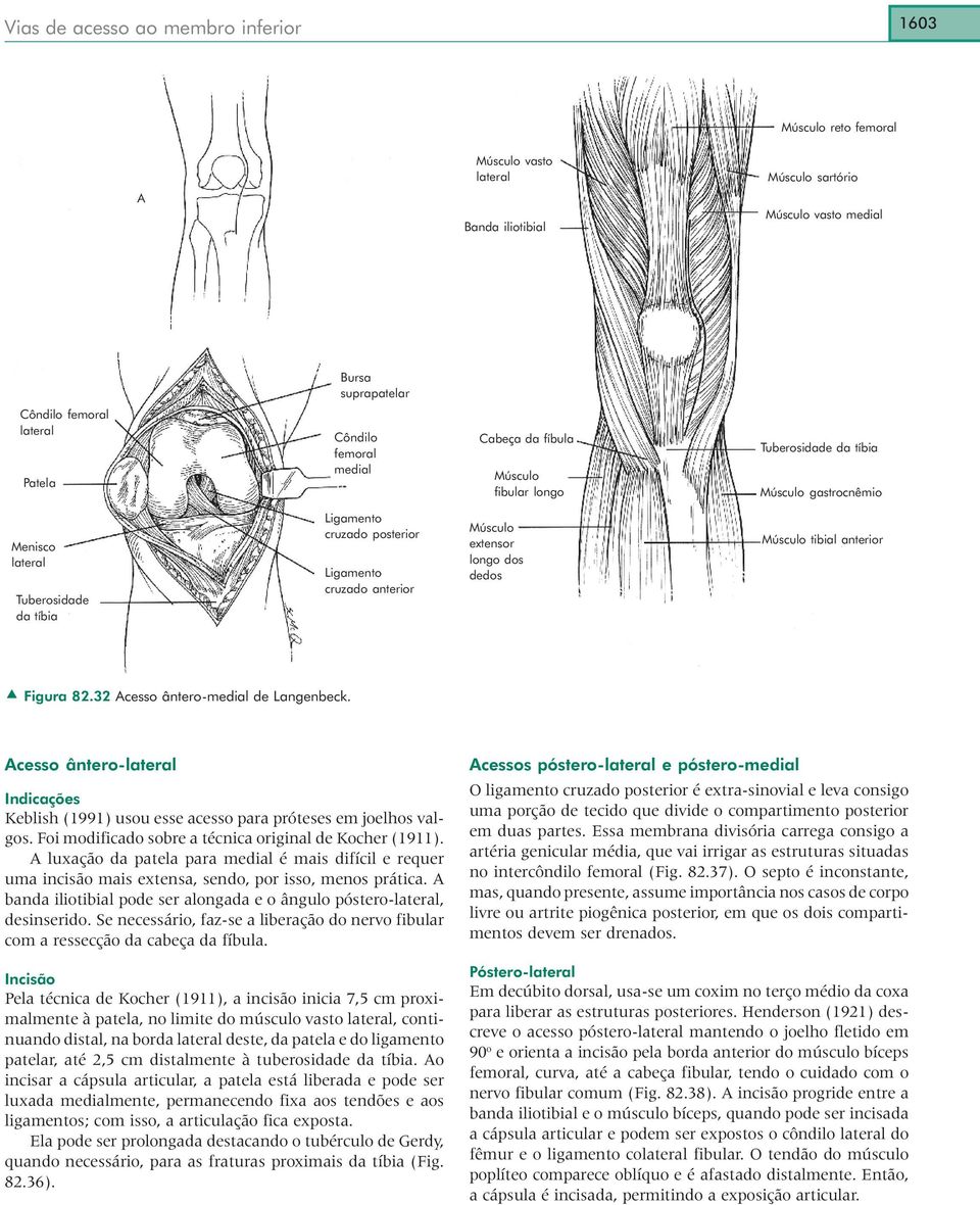 32 Acesso ântero-medial de Langenbeck. Acesso ântero- Indicações Keblish (1991) usou esse acesso para próteses em joelhos valgos. Foi modificado sobre a técnica original de Kocher (1911).
