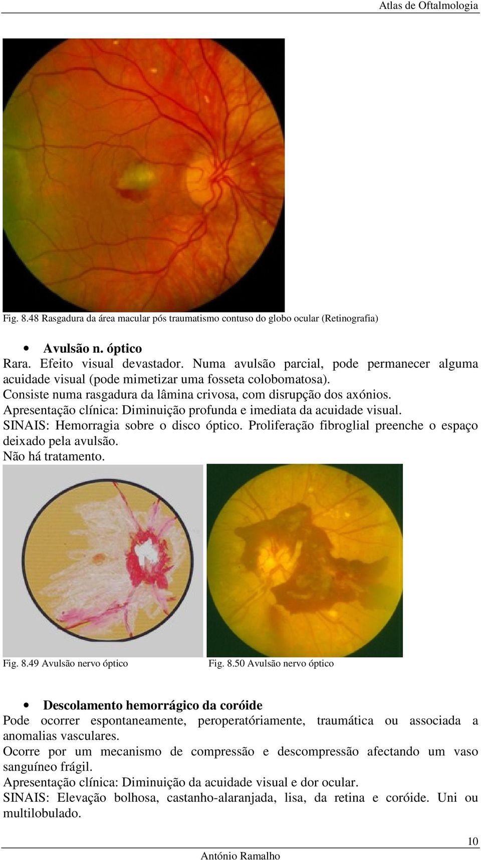 Apresentação clínica: Diminuição profunda e imediata da acuidade visual. SINAIS: Hemorragia sobre o disco óptico. Proliferação fibroglial preenche o espaço deixado pela avulsão. Não há tratamento.