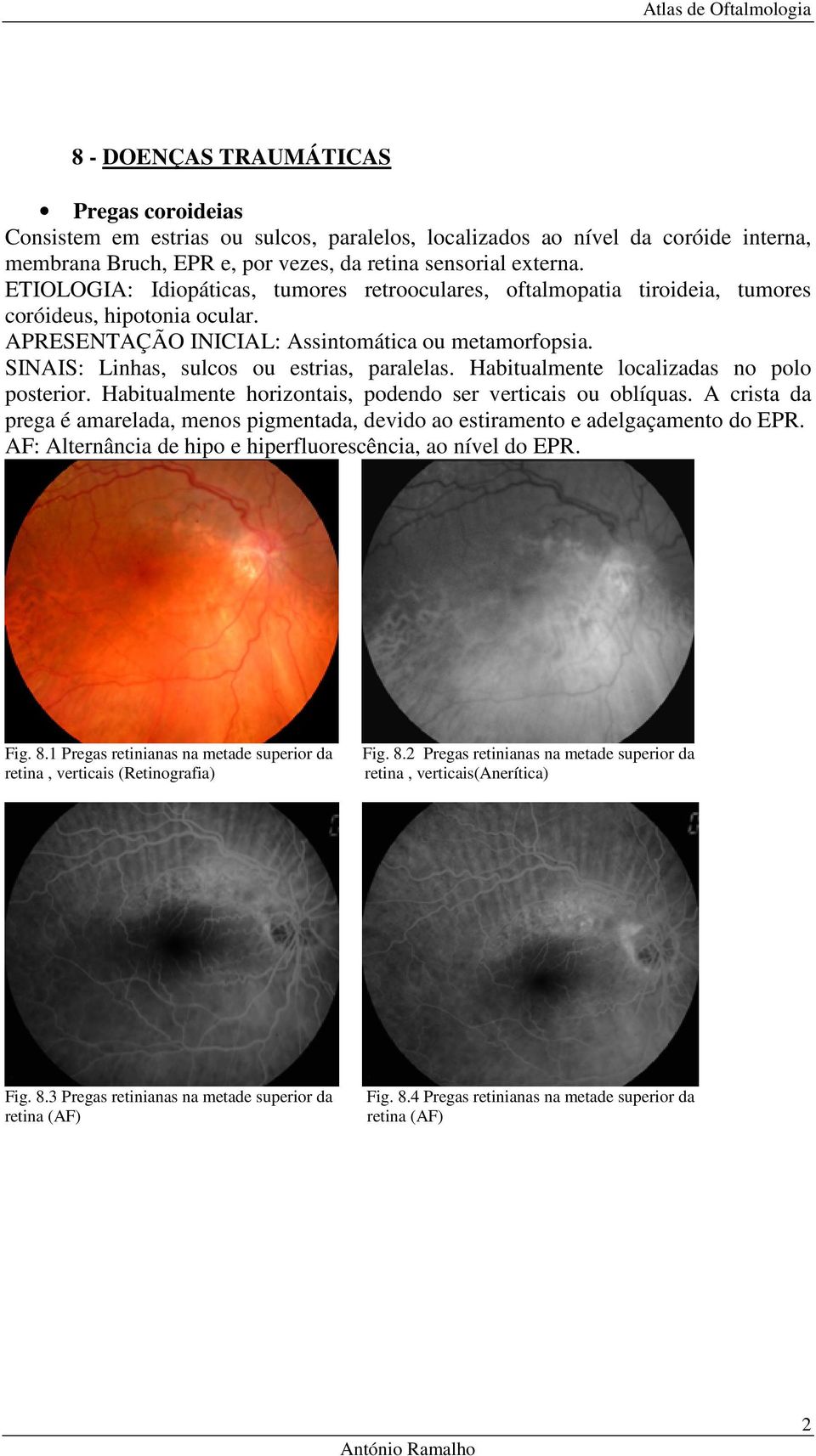 SINAIS: Linhas, sulcos ou estrias, paralelas. Habitualmente localizadas no polo posterior. Habitualmente horizontais, podendo ser verticais ou oblíquas.