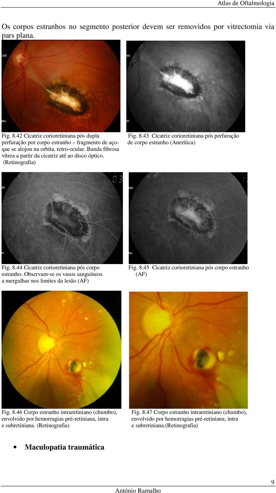 (Retinografia) Fig. 8.43 Cicatriz corioretiniana pós perfuração de corpo estranho (Anerítica) Fig. 8.44 Cicatriz corioretiniana pós corpo estranho.