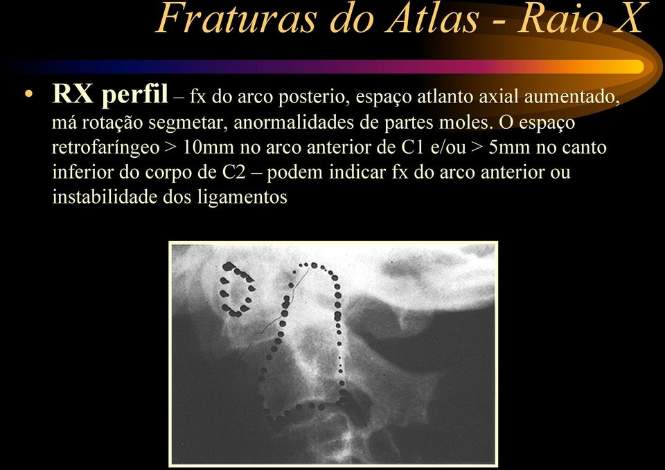 O espaço retrofaríngeo > 10mm no arco anterior de C1 e/ou > 5mm no canto