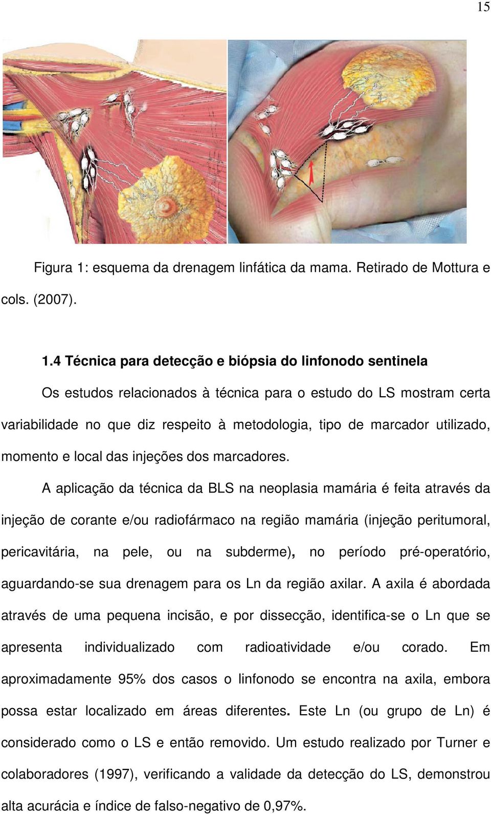 4 Técnica para detecção e biópsia do linfonodo sentinela Os estudos relacionados à técnica para o estudo do LS mostram certa variabilidade no que diz respeito à metodologia, tipo de marcador