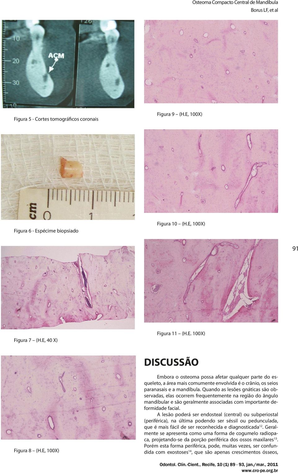 Quando as lesões gnáticas são observadas, elas ocorrem frequentemente na região do ângulo mandibular e são geralmente associadas com importante deformidade facial.