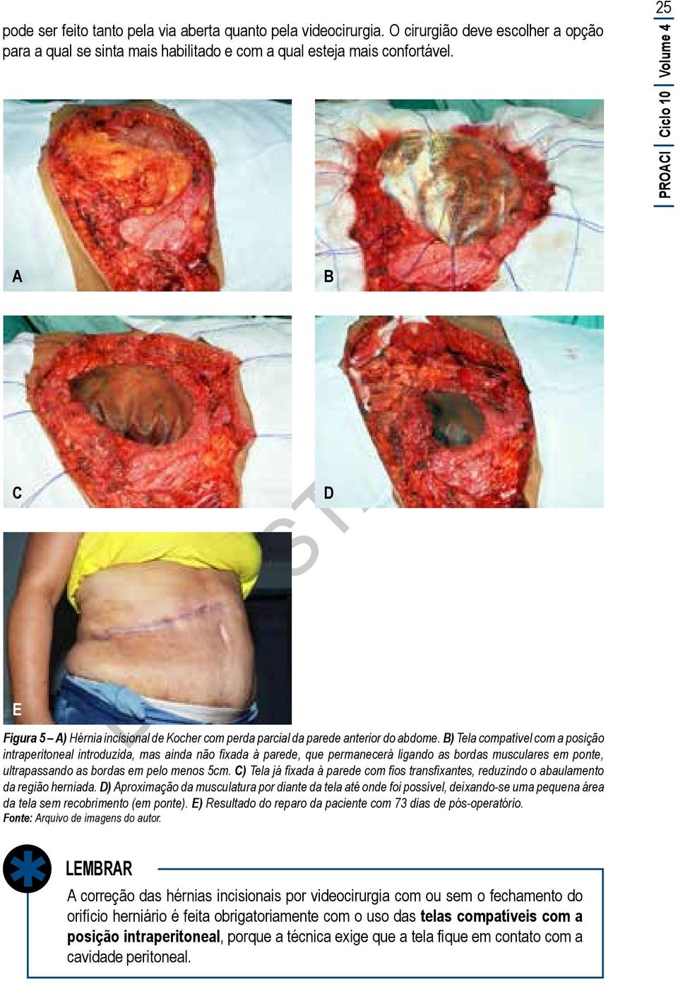 B) Tela compatível com a posição intraperitoneal introduzida, mas ainda não fixada à parede, que permanecerá ligando as bordas musculares em ponte, ultrapassando as bordas em pelo menos 5cm.