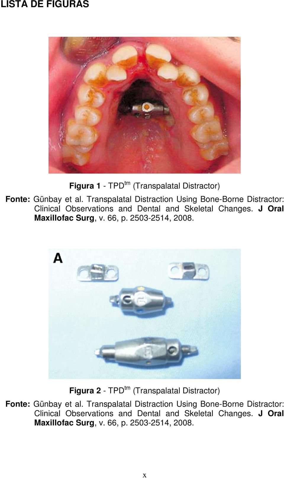 J Oral Maxillofac Surg, v. 66, p. 2503-2514, 2008. Figura 2 - TPD tm (Transpalatal Distractor) Fonte: Günbay et al.
