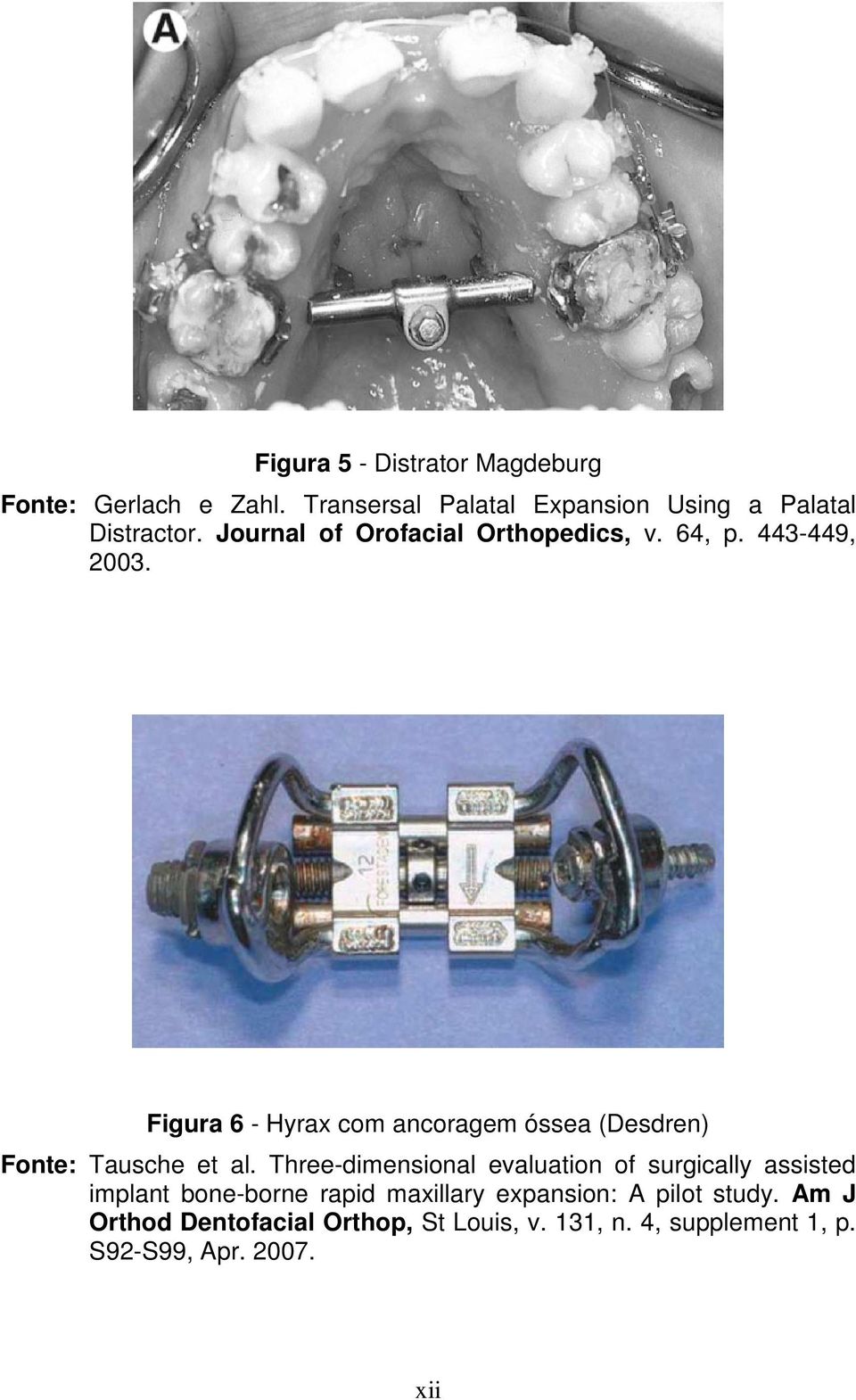 Figura 6 - Hyrax com ancoragem óssea (Desdren) Fonte: Tausche et al.