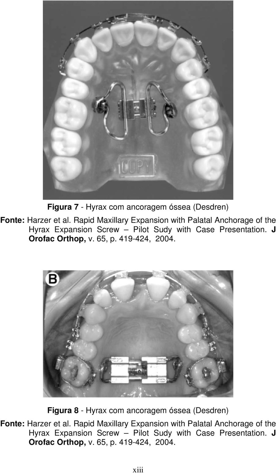 J Orofac Orthop, v. 65, p. 419-424, 2004. Figura 8 - Hyrax com ancoragem óssea (Desdren) Fonte: Harzer et al.