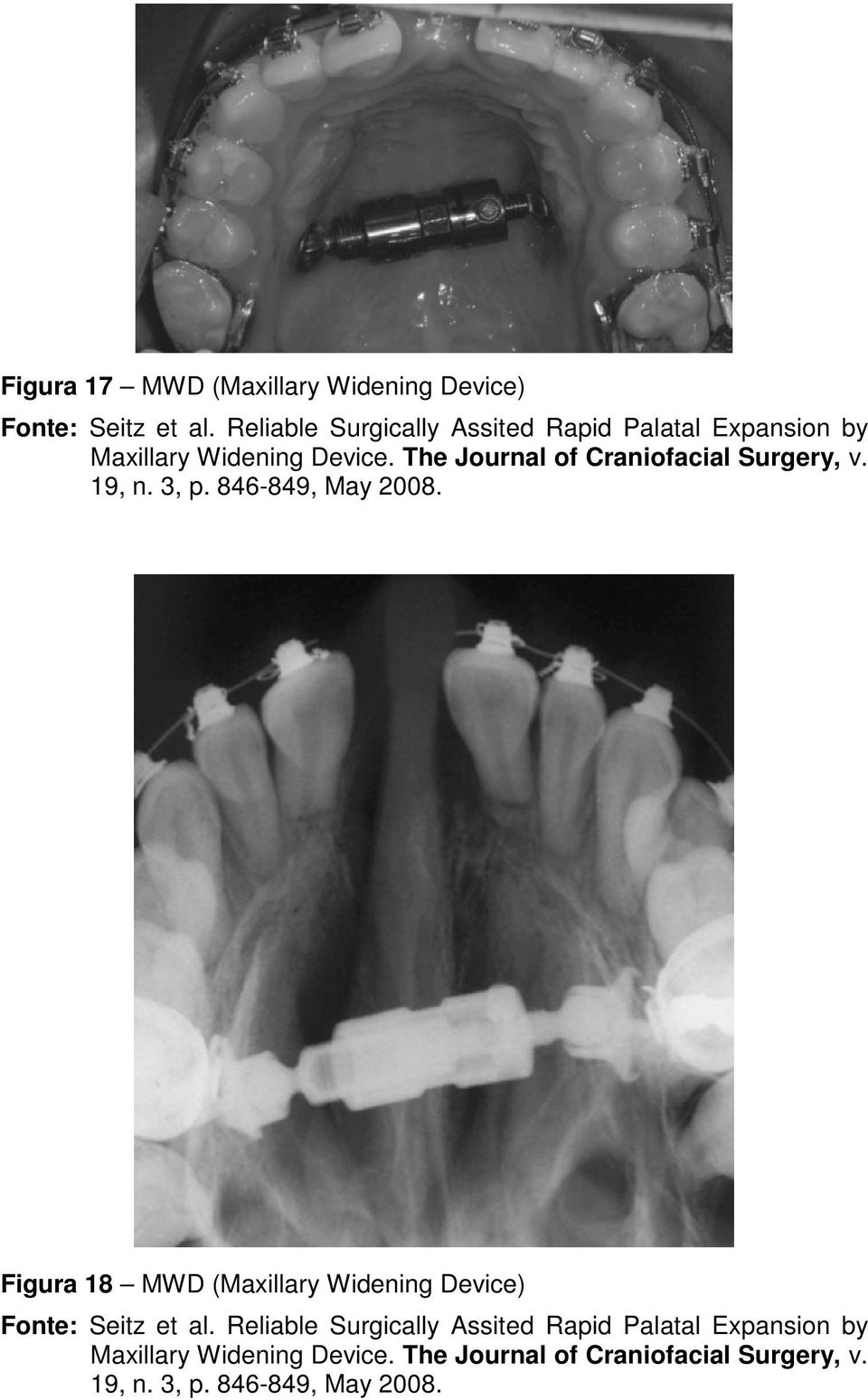 The Journal of Craniofacial Surgery, v. 19, n. 3, p. 846-849, May 2008.