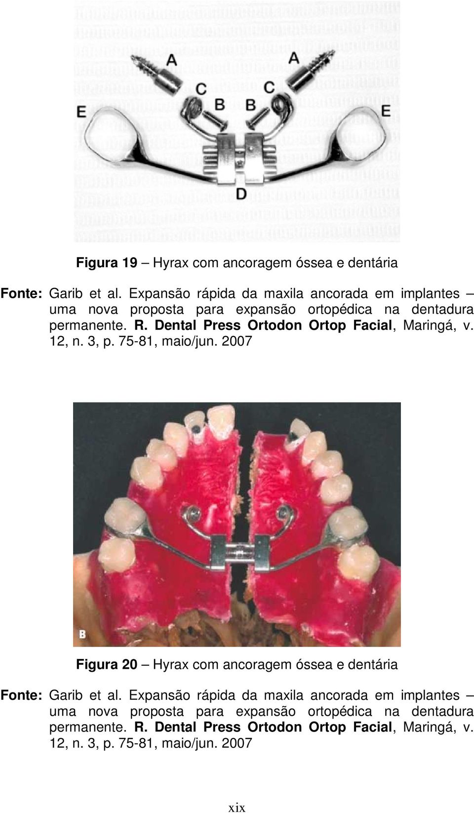 Dental Press Ortodon Ortop Facial, Maringá, v. 12, n. 3, p. 75-81, maio/jun.