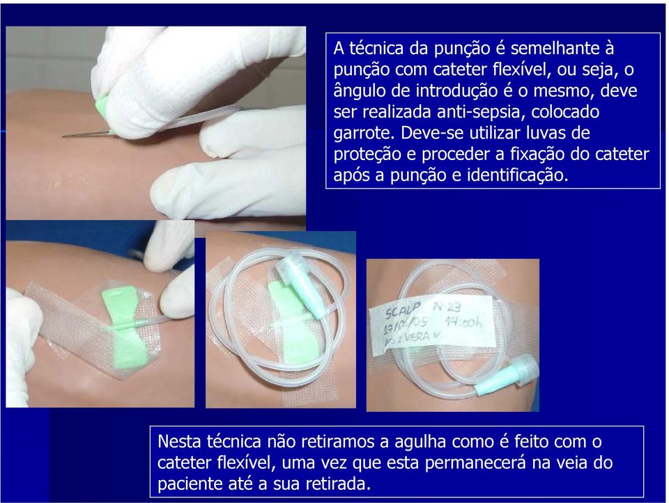 Deve-se utilizar luvas de proteção e proceder a fixação do cateter após a punção e identificação.