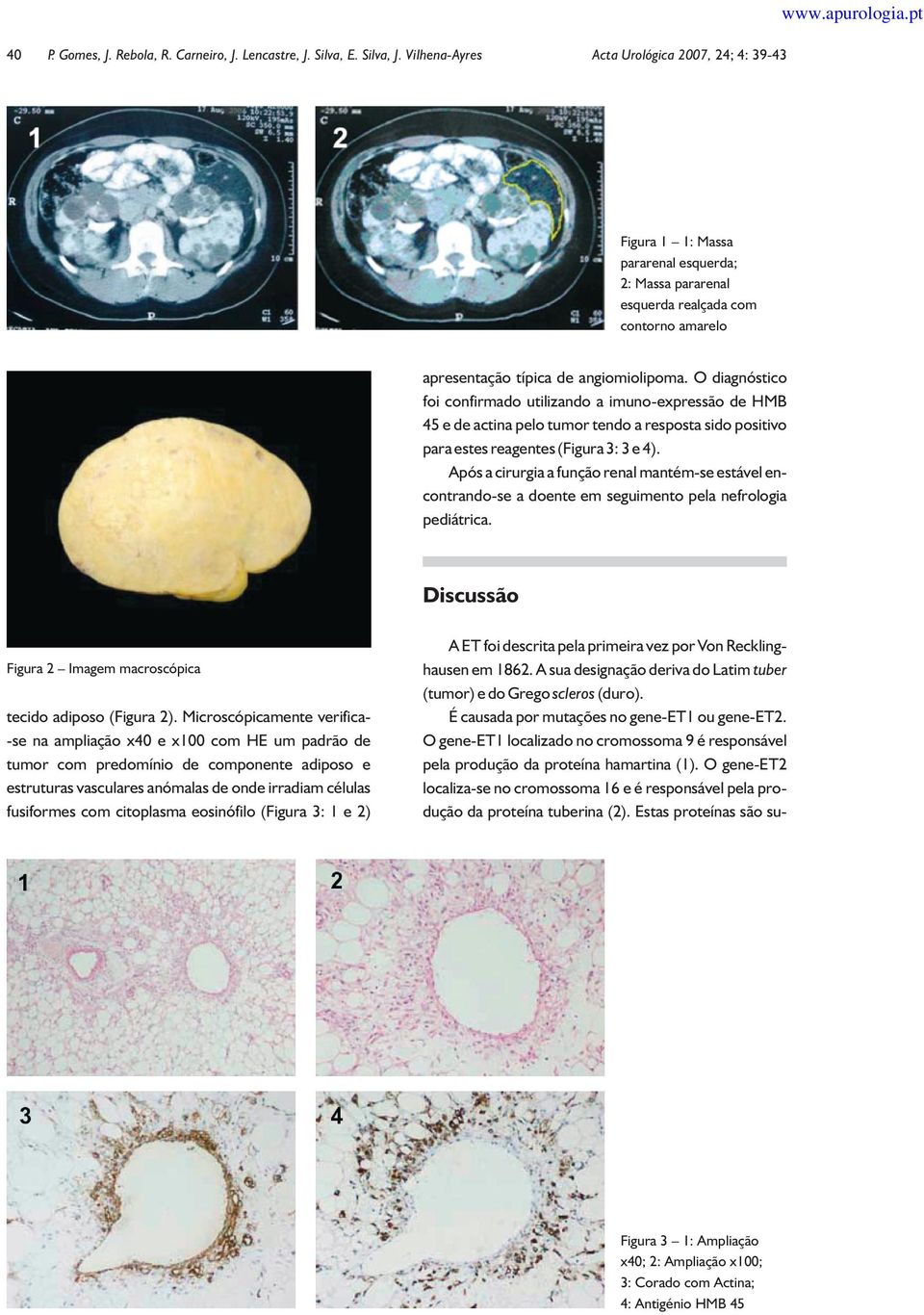 O diagnóstico foi confirmado utilizando a imuno-expressão de HMB 45 e de actina pelo tumor tendo a resposta sido positivo para estes reagentes (Figura 3:3 e 4).