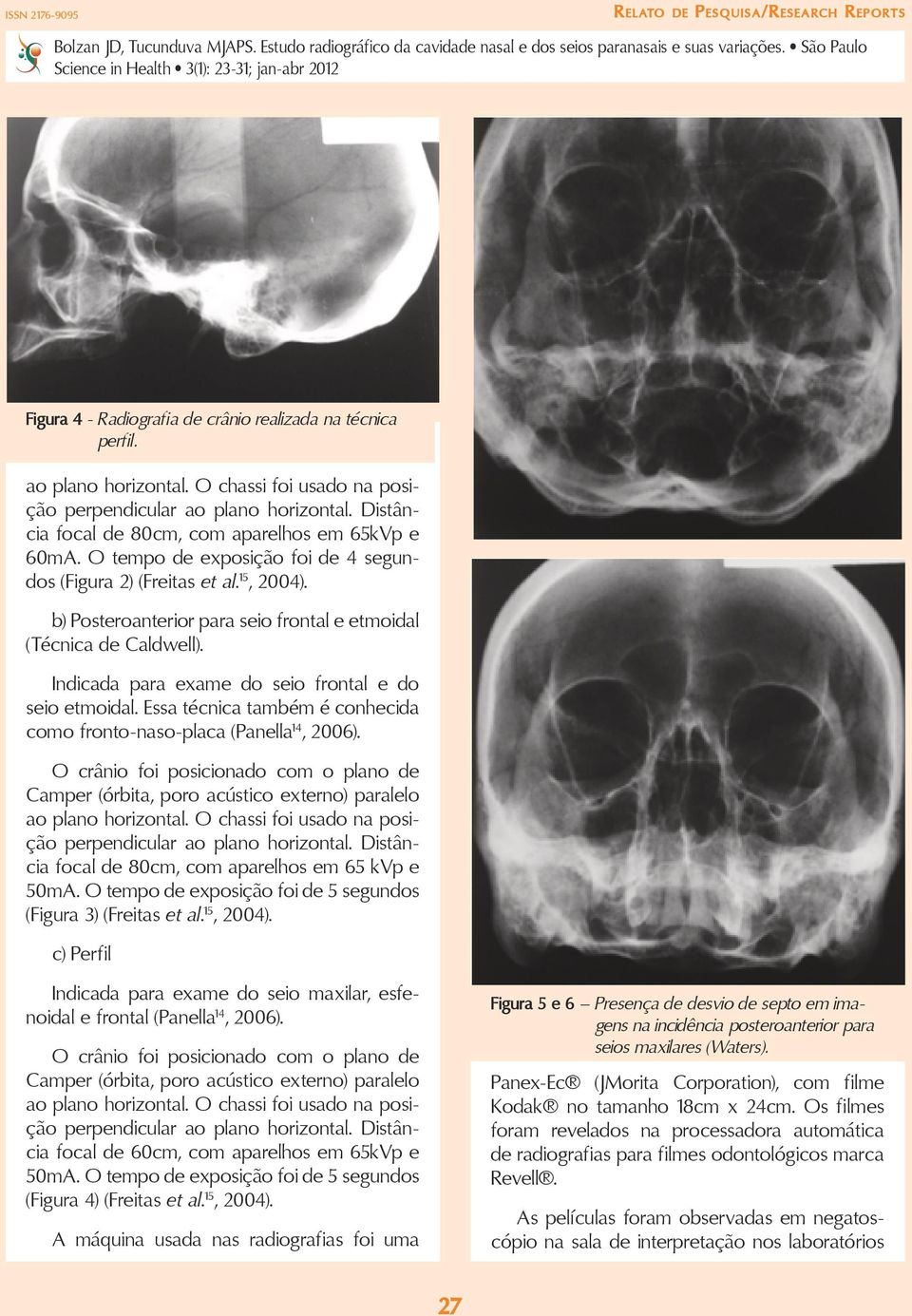 b) Posteroanterior para seio frontal e etmoidal (Técnica de Caldwell). Indicada para exame do seio frontal e do seio etmoidal.