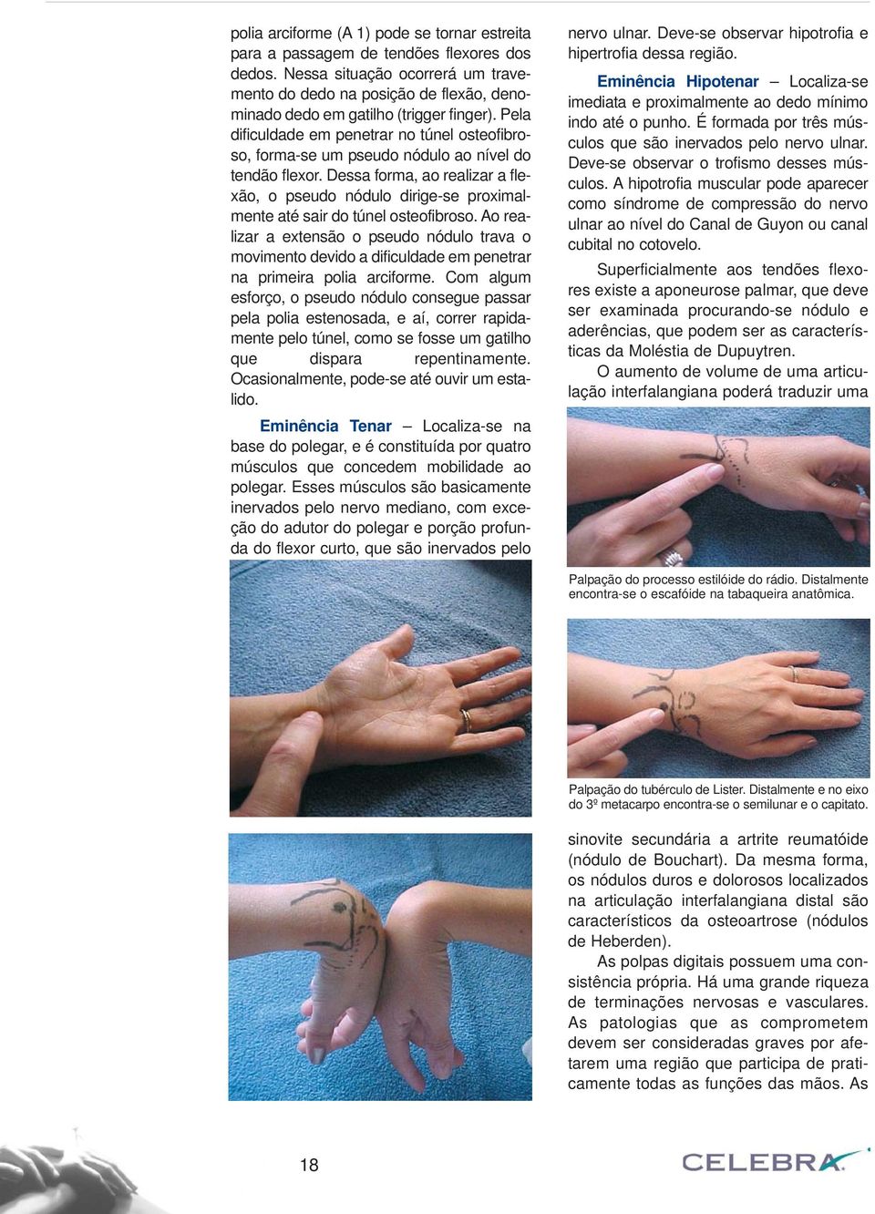 Pela dificuldade em penetrar no túnel osteofibroso, forma-se um pseudo nódulo ao nível do tendão flexor.