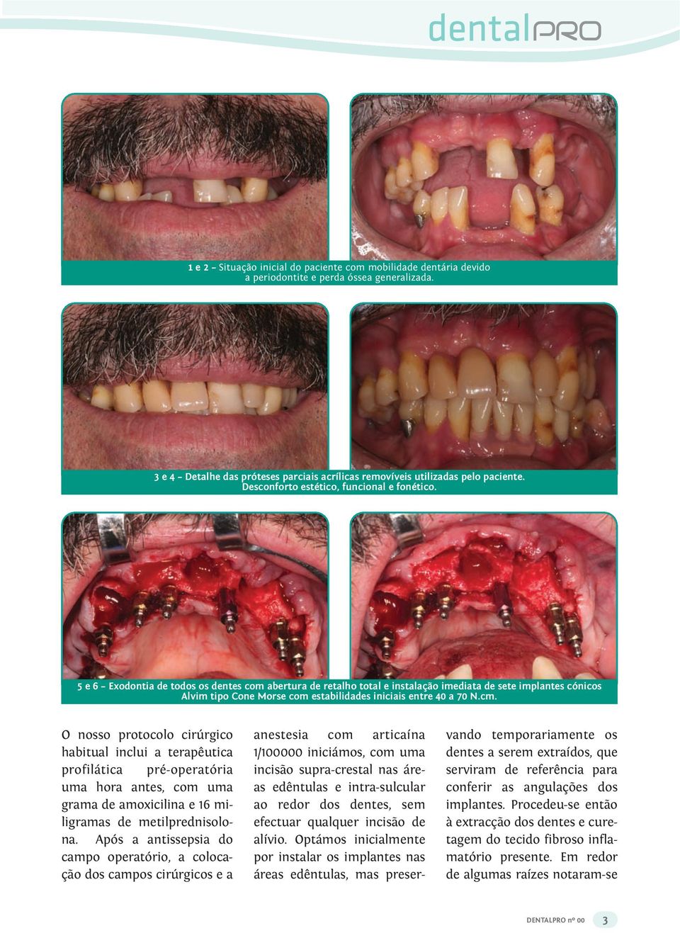 5 e 6 Exodontia de todos os dentes com abertura de retalho total e instalação imediata de sete implantes cónicos Alvim tipo Cone Morse com estabilidades iniciais entre 40 a 70 N.cm.