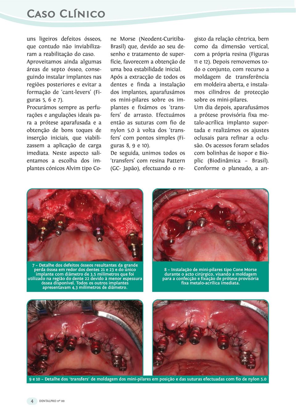 Procurámos sempre as perfurações e angulações ideais para a prótese aparafusada e a obtenção de bons toques de inserção iniciais, que viabilizassem a aplicação de carga imediata.