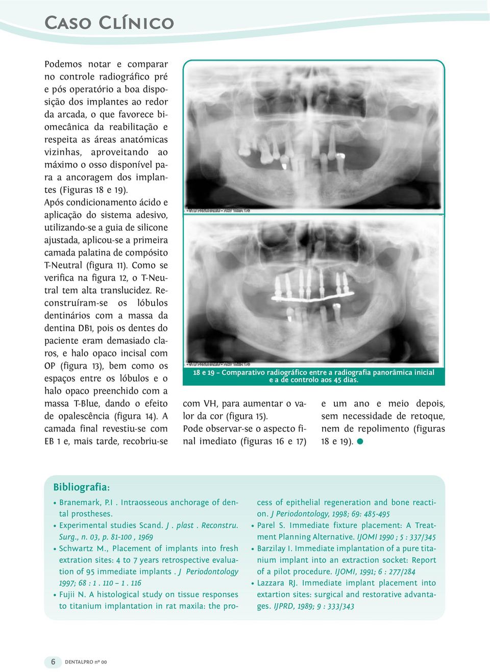 Após condicionamento ácido e aplicação do sistema adesivo, utilizando-se a guia de silicone ajustada, aplicou-se a primeira camada palatina de compósito T-Neutral (figura 11).