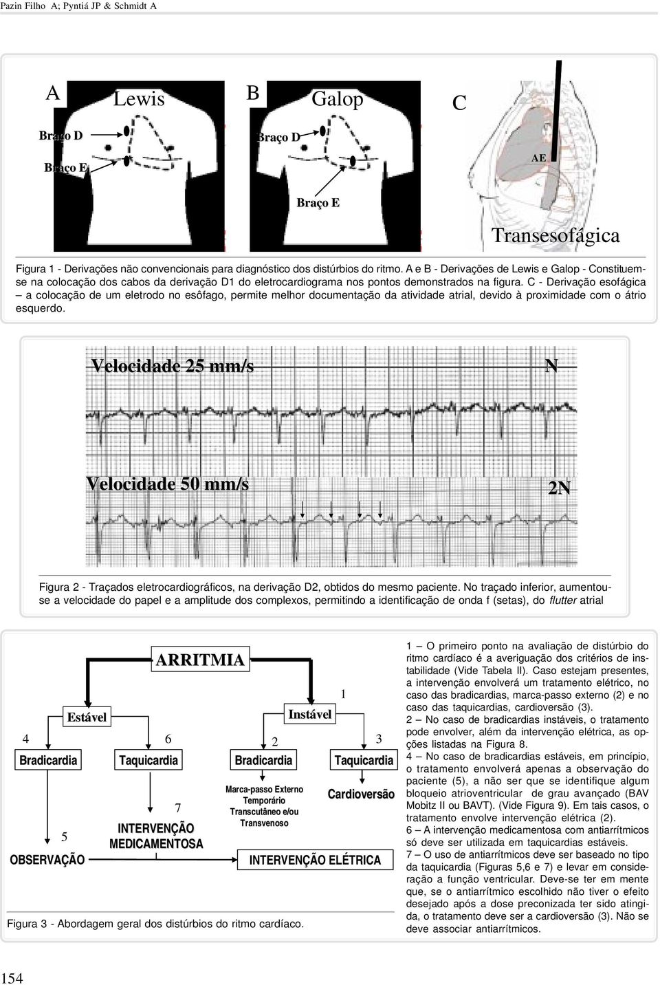 C - Derivação esofágica a colocação de um eletrodo no esôfago, permite melhor documentação da atividade atrial, devido à proximidade com o átrio esquerdo.