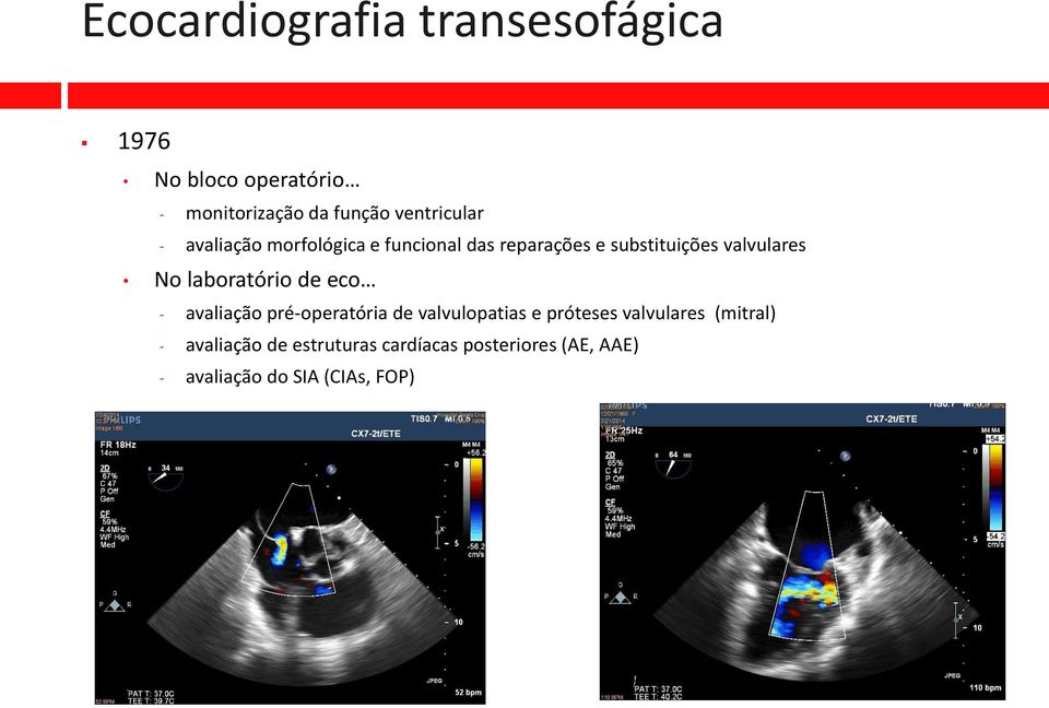 No laboratório de eco - avaliação pré-operatória de valvulopatias e próteses valvulares
