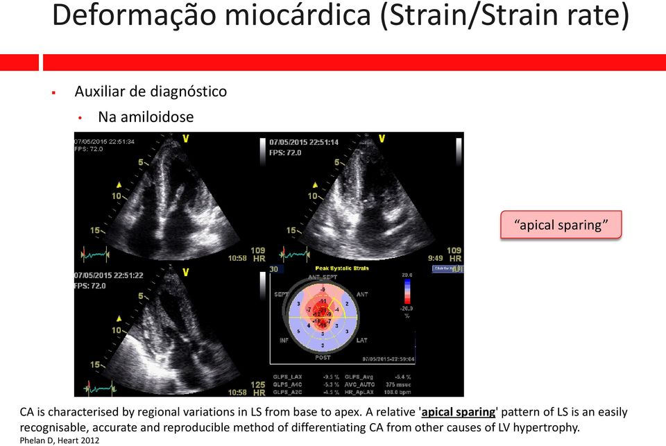 A relative 'apical sparing' pattern of LS is an easily recognisable, accurate and