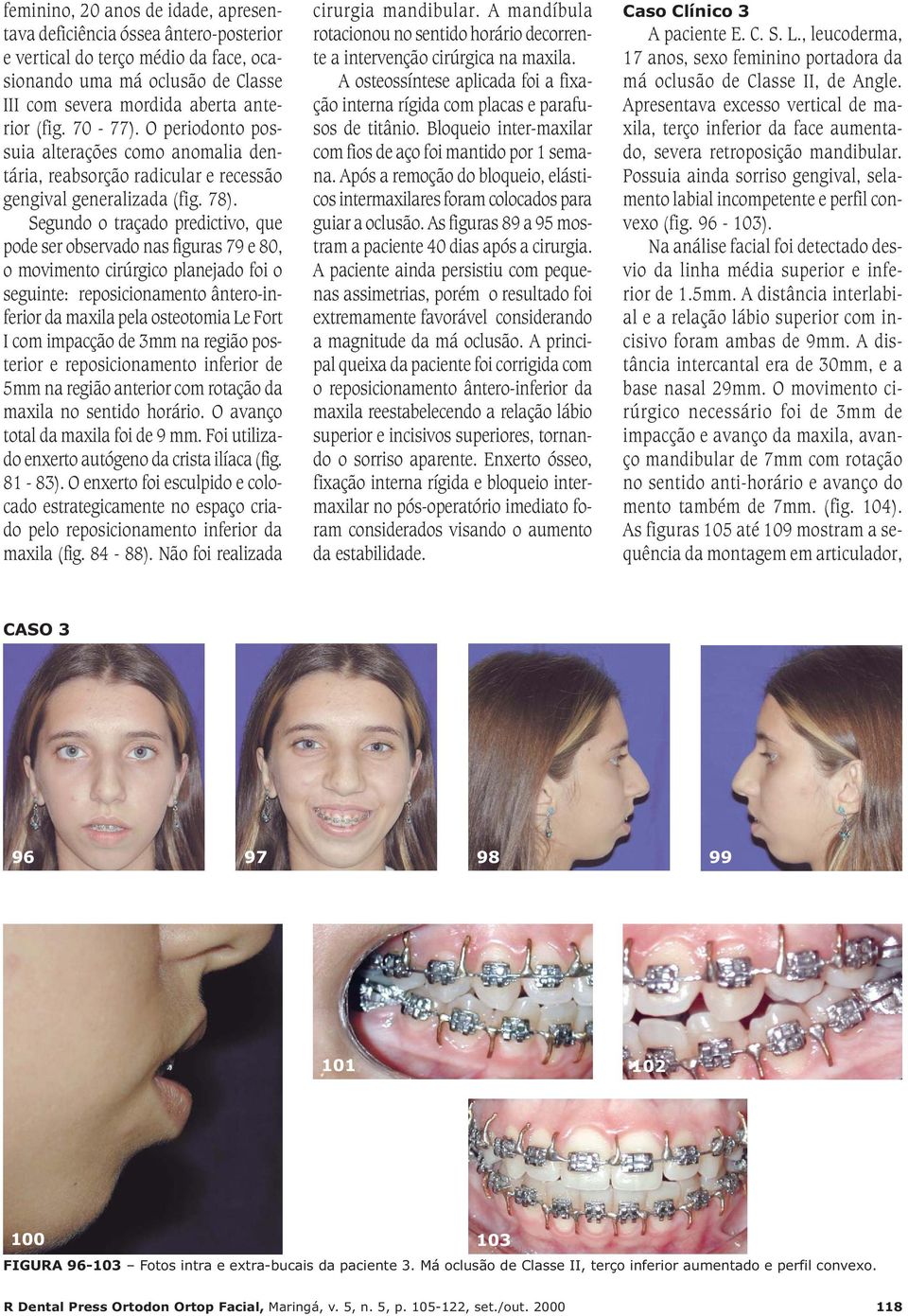 Segundo o traçado predictivo, que pode ser observado nas figuras 79 e 80, o movimento cirúrgico planejado foi o seguinte: reposicionamento ântero-inferior da maxila pela osteotomia Le Fort I com