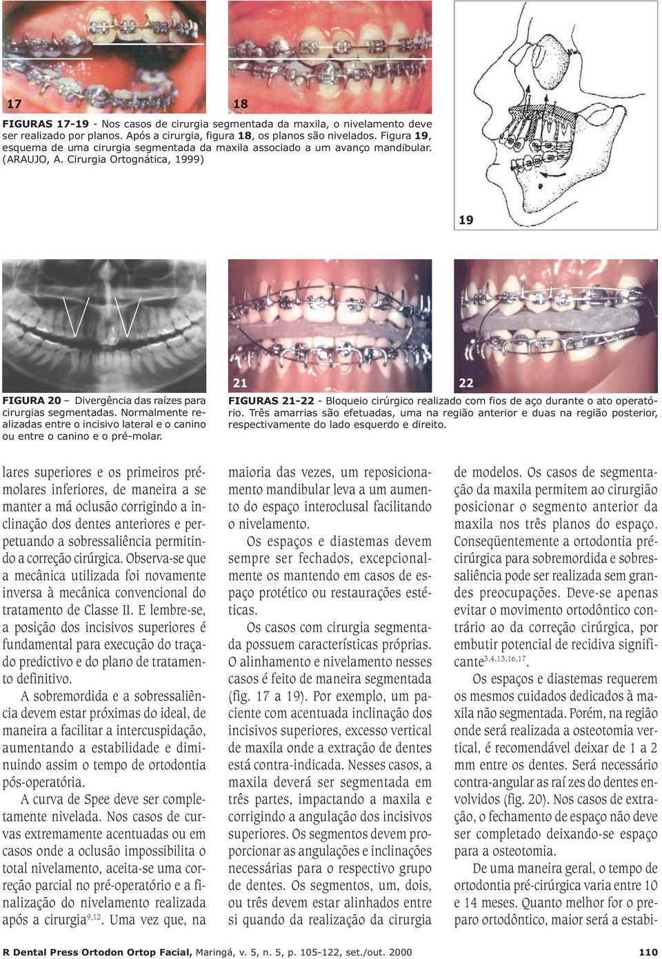 Normalmente realizadas entre o incisivo lateral e o canino ou entre o canino e o pré-molar. 21 22 FIGURAS 21-22 - Bloqueio cirúrgico realizado com fios de aço durante o ato operatório.