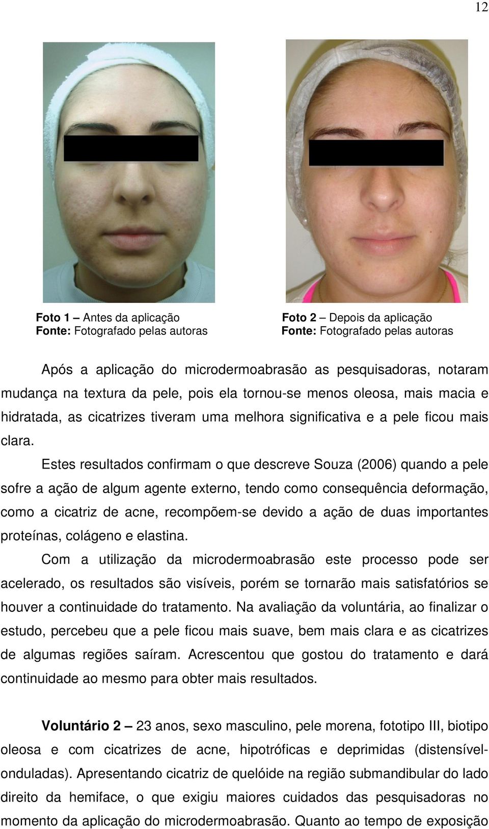 Estes resultados confirmam o que descreve Souza (2006) quando a pele sofre a ação de algum agente externo, tendo como consequência deformação, como a cicatriz de acne, recompõem-se devido a ação de