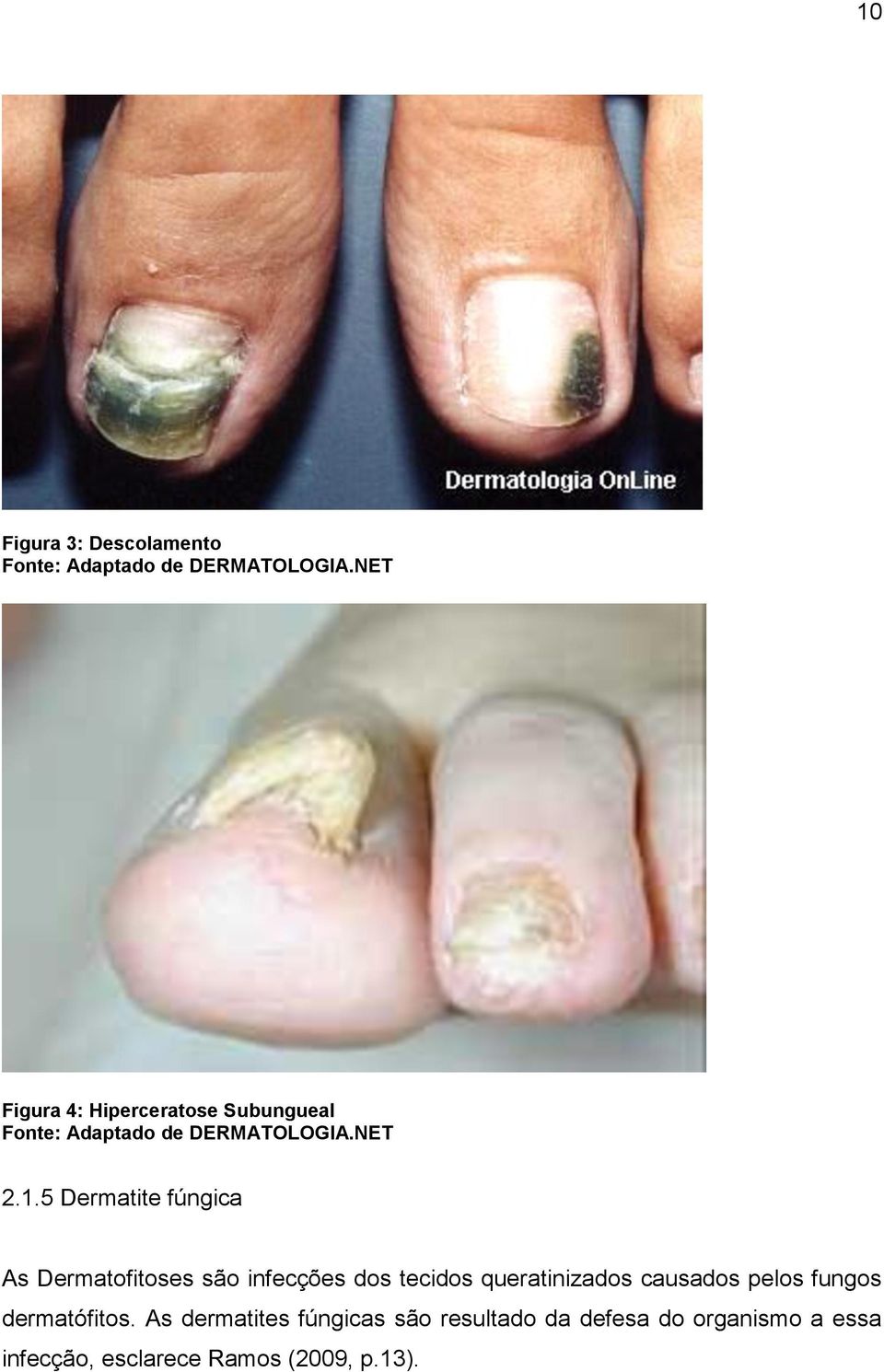5 Dermatite fúngica As Dermatofitoses são infecções dos tecidos queratinizados causados