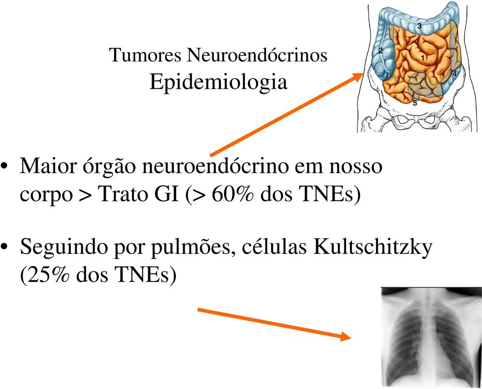 > Trato GI (> 60% dos TNEs) Seguindo por