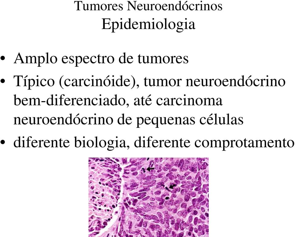 bem-diferenciado, até carcinoma neuroendócrino de