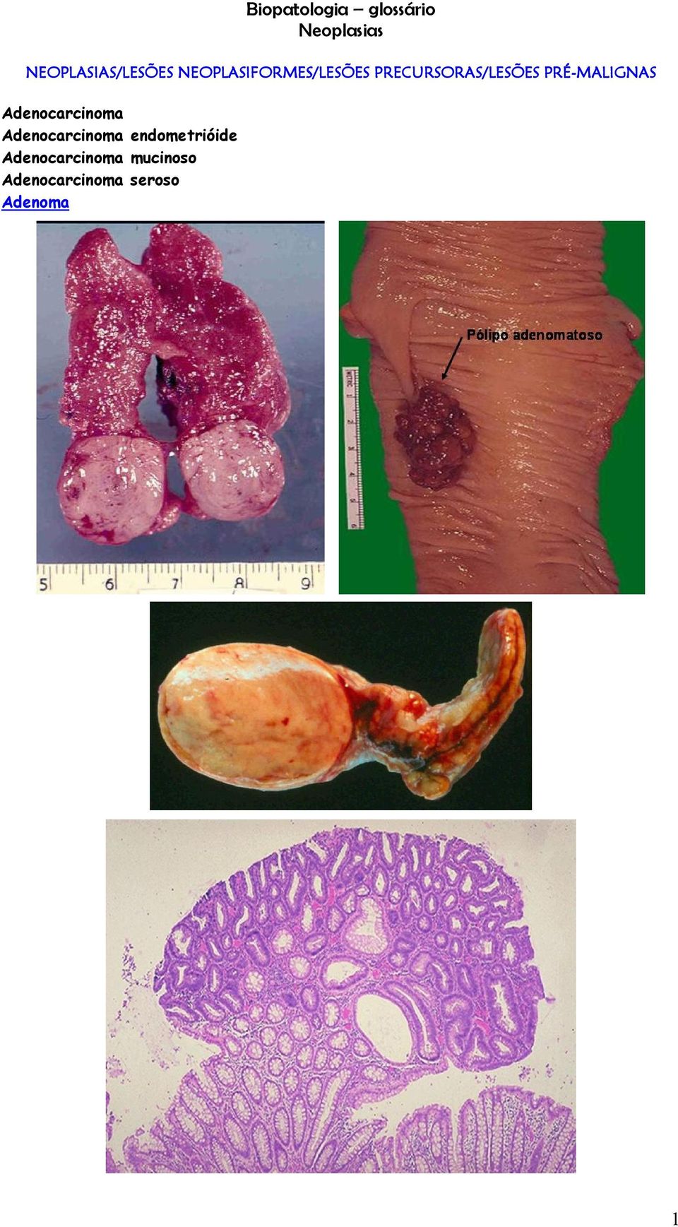 Adenocarcinoma Adenocarcinoma