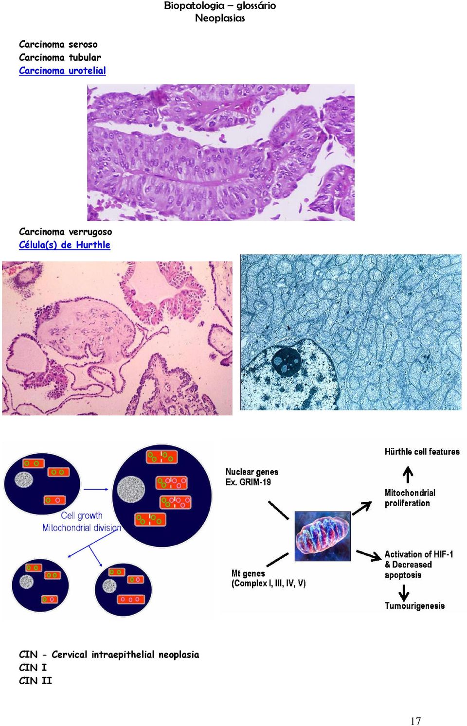 Carcinoma verrugoso Célula(s) de Hurthle