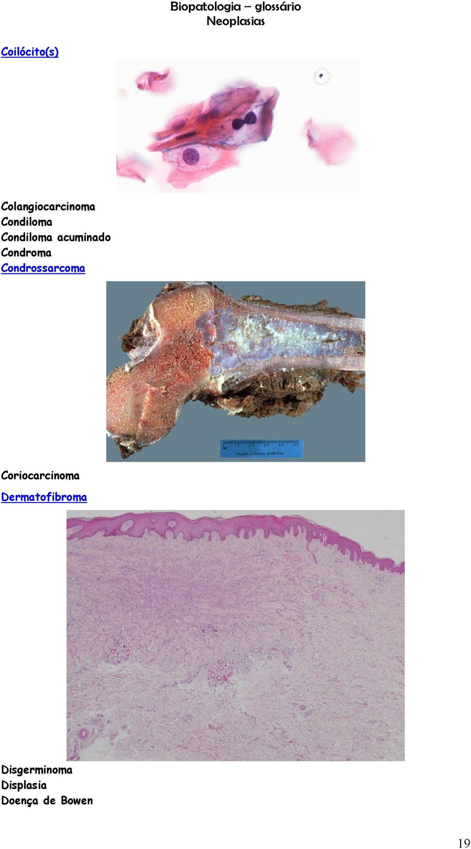 Condrossarcoma Coriocarcinoma