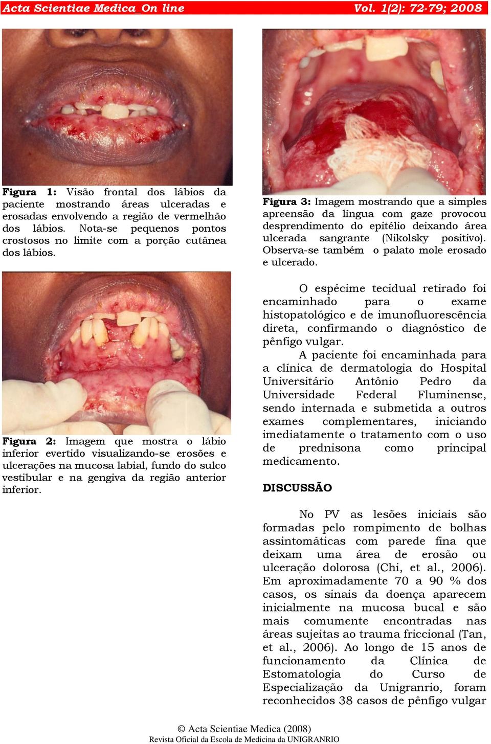 Figura 2: Imagem que mostra o lábio inferior evertido visualizando-se erosões e ulcerações na mucosa labial, fundo do sulco vestibular e na gengiva da região anterior inferior.