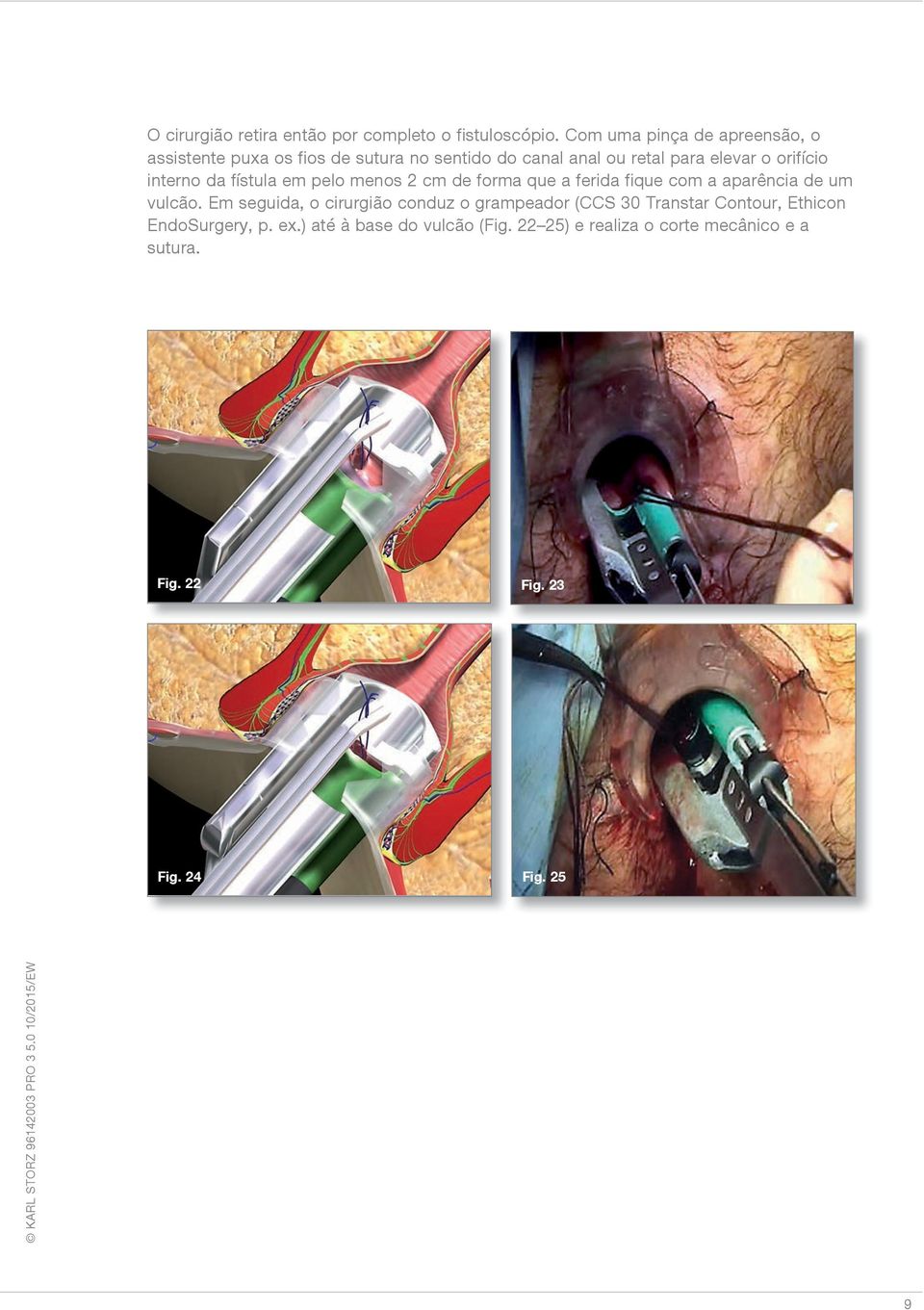 orifício interno da fístula em pelo menos 2 cm de forma que a ferida fique com a aparência de um vulcão.