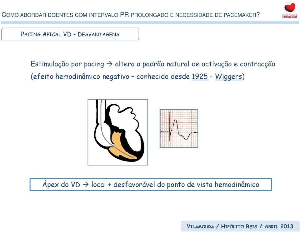 hemodinâmico negativo conhecido desde 1925 - Wiggers)