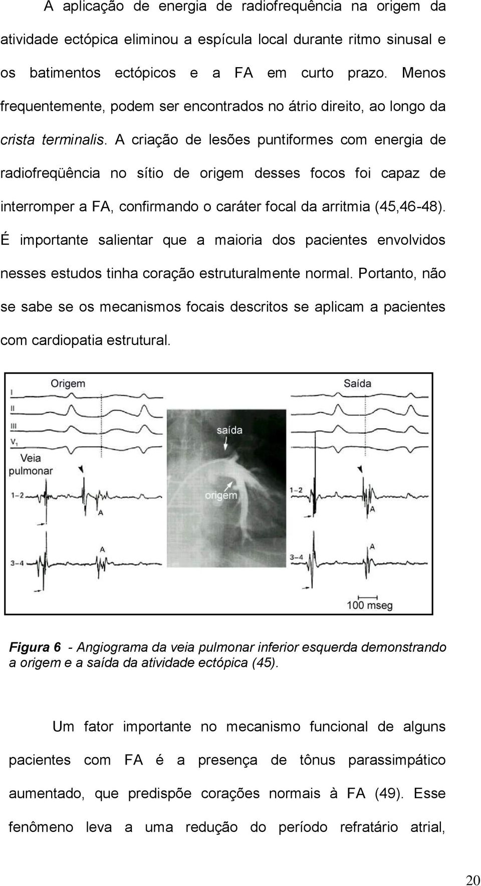 A criação de lesões puntiformes com energia de radiofreqüência no sítio de origem desses focos foi capaz de interromper a FA, confirmando o caráter focal da arritmia (45,46-48).