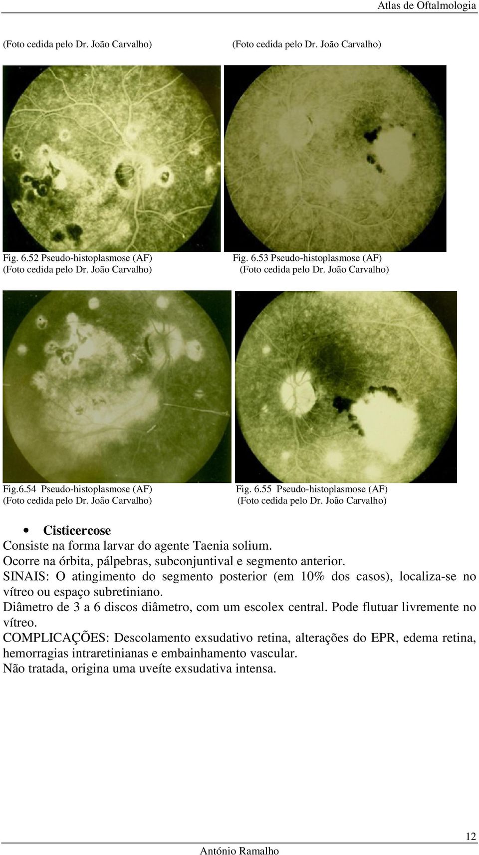 SINAIS: O atingimento do segmento posterior (em 10% dos casos), localiza-se no vítreo ou espaço subretiniano.