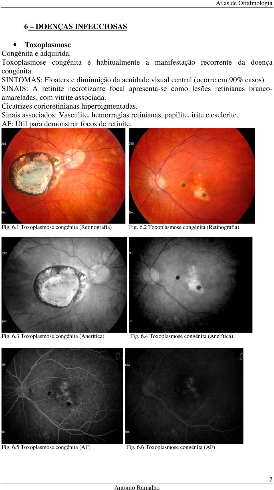 associada. Cicatrizes corioretinianas hiperpigmentadas. Sinais associados: Vasculite, hemorragias retinianas, papilite, irite e esclerite. AF: Útil para demonstrar focos de retinite. Fig. 6.