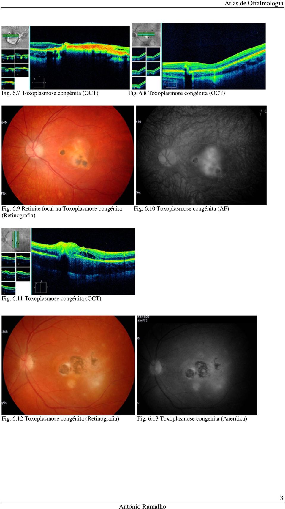 10 Toxoplasmose congénita (AF) Fig. 6.