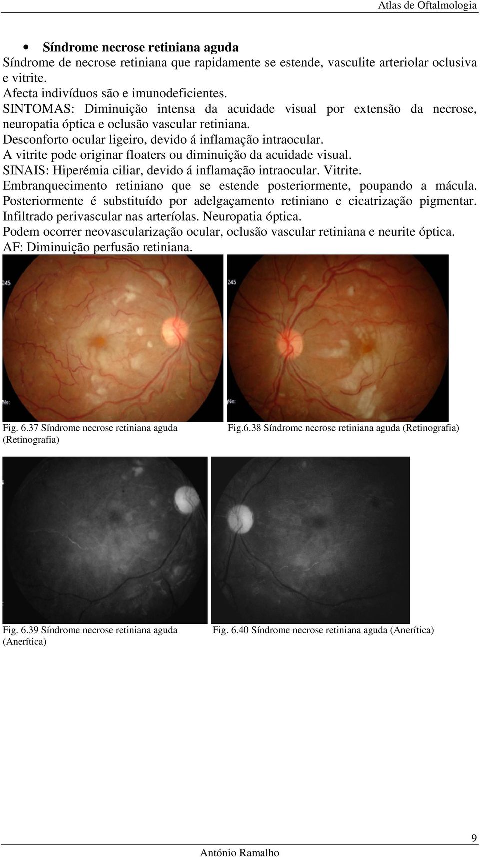 A vitrite pode originar floaters ou diminuição da acuidade visual. SINAIS: Hiperémia ciliar, devido á inflamação intraocular. Vitrite.