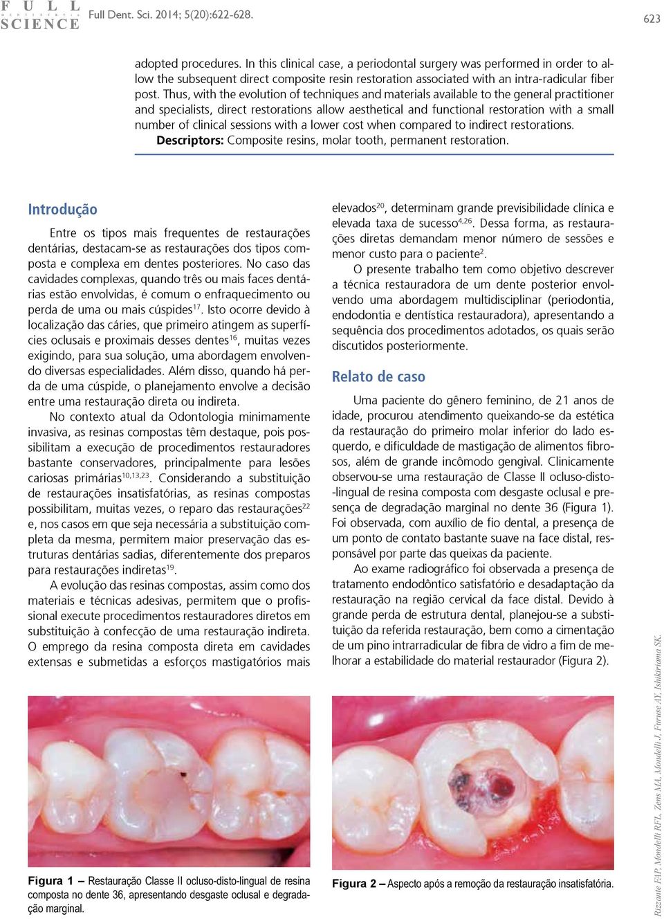 clinical sessions with a lower cost when compared to indirect restorations. Descriptors: Composite resins, molar tooth, permanent restoration.