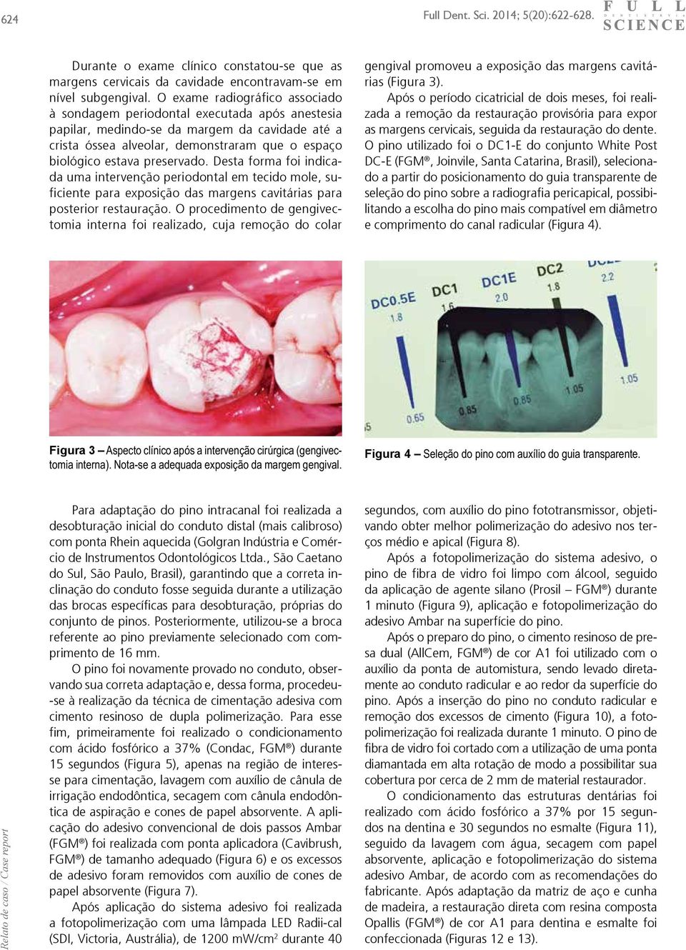 preservado. Desta forma foi indicada uma intervenção periodontal em tecido mole, suficiente para exposição das margens cavitárias para posterior restauração.