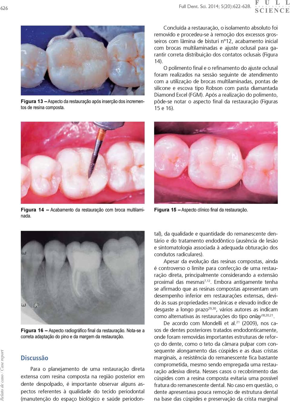 para garantir correta distribuição dos contatos oclusais (Figura 14).