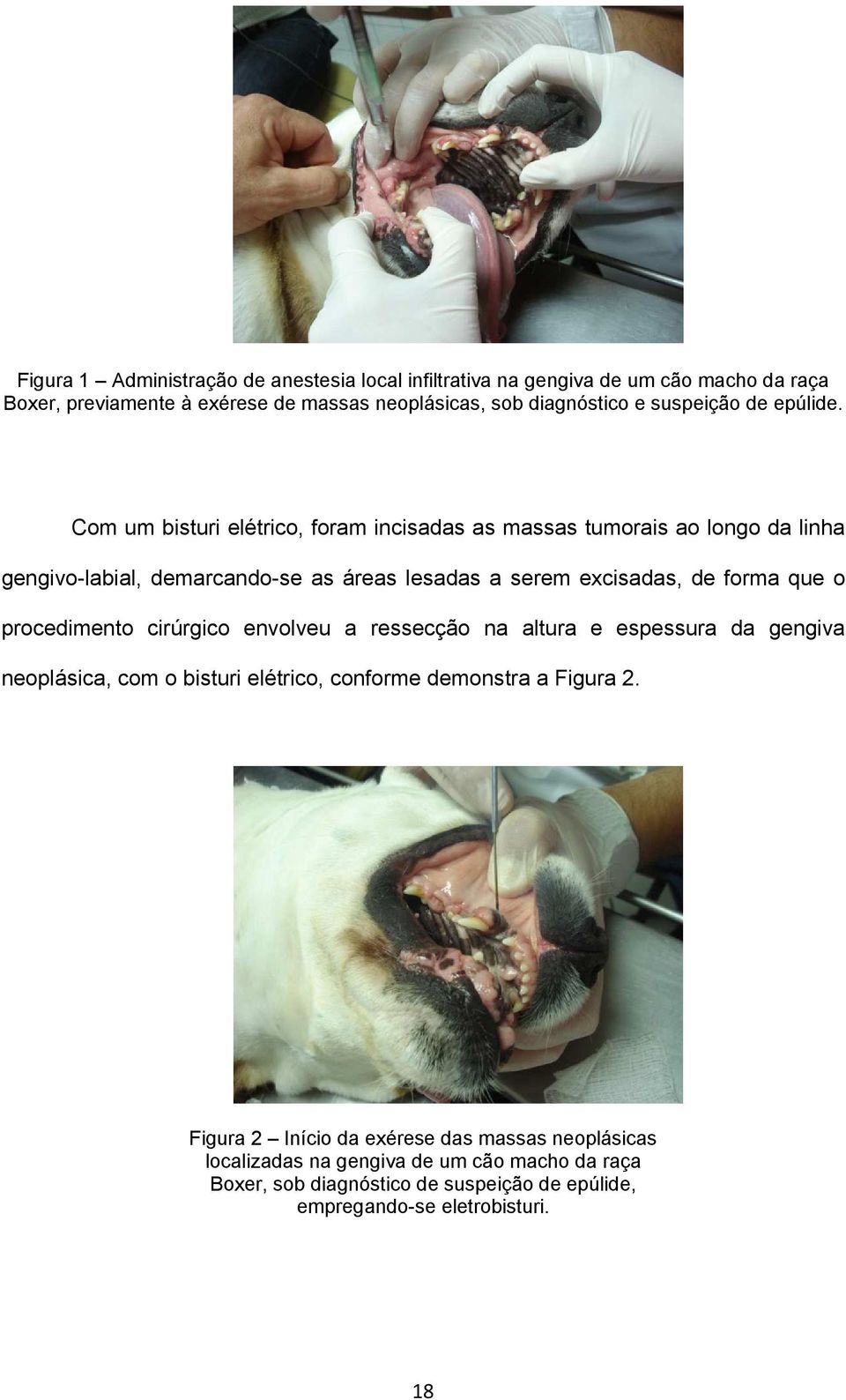 Com um bisturi elétrico, foram incisadas as massas tumorais ao longo da linha gengivo-labial, demarcando-se as áreas lesadas a serem excisadas, de forma que o