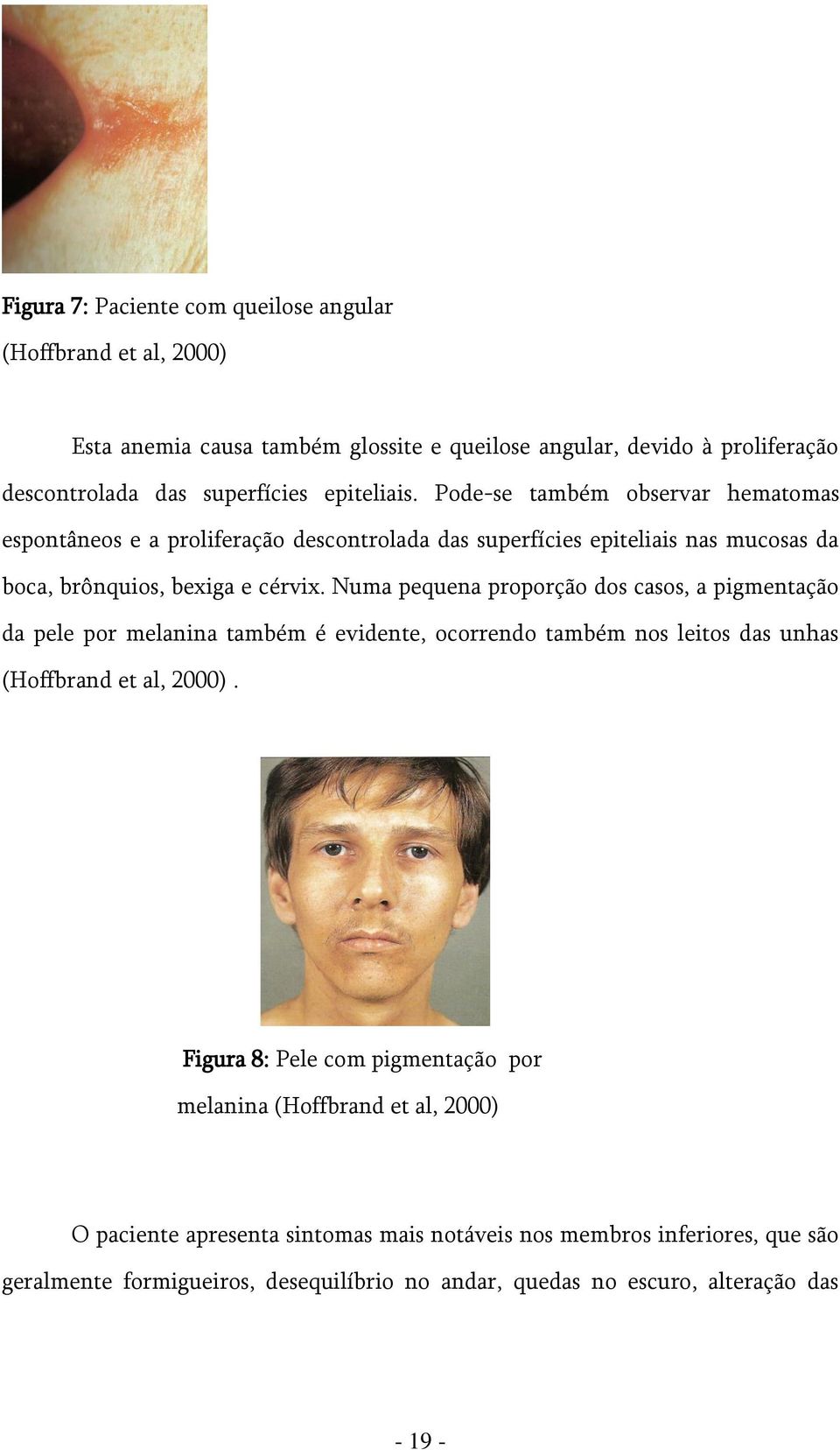 Numa pequena proporção dos casos, a pigmentação da pele por melanina também é evidente, ocorrendo também nos leitos das unhas (Hoffbrand et al, 2000).