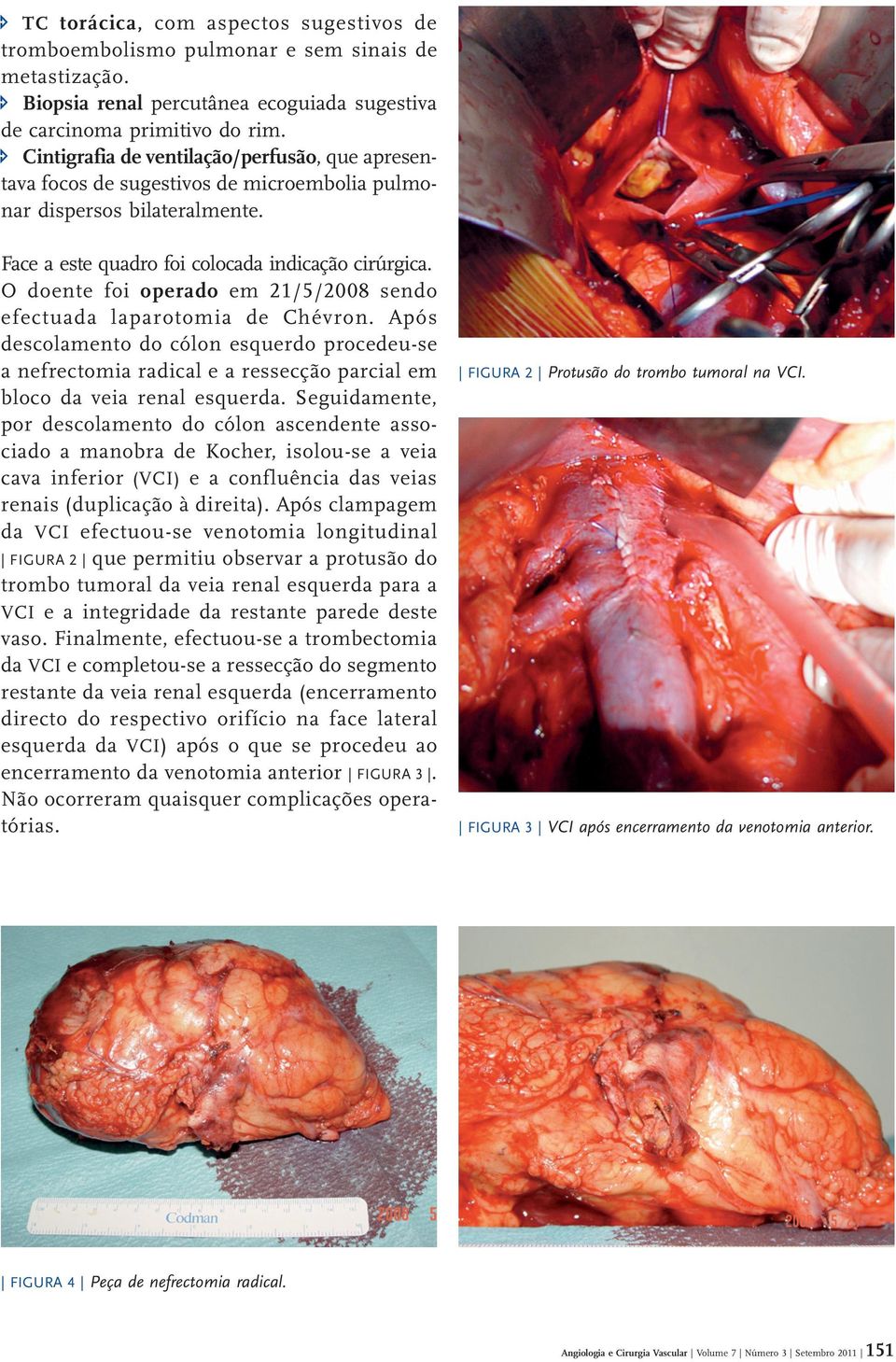 O doente foi operado em 21/5/2008 sendo efectuada laparotomia de Chévron. Após descolamento do cólon esquerdo procedeu se a nefrectomia radical e a ressecção parcial em bloco da veia renal esquerda.