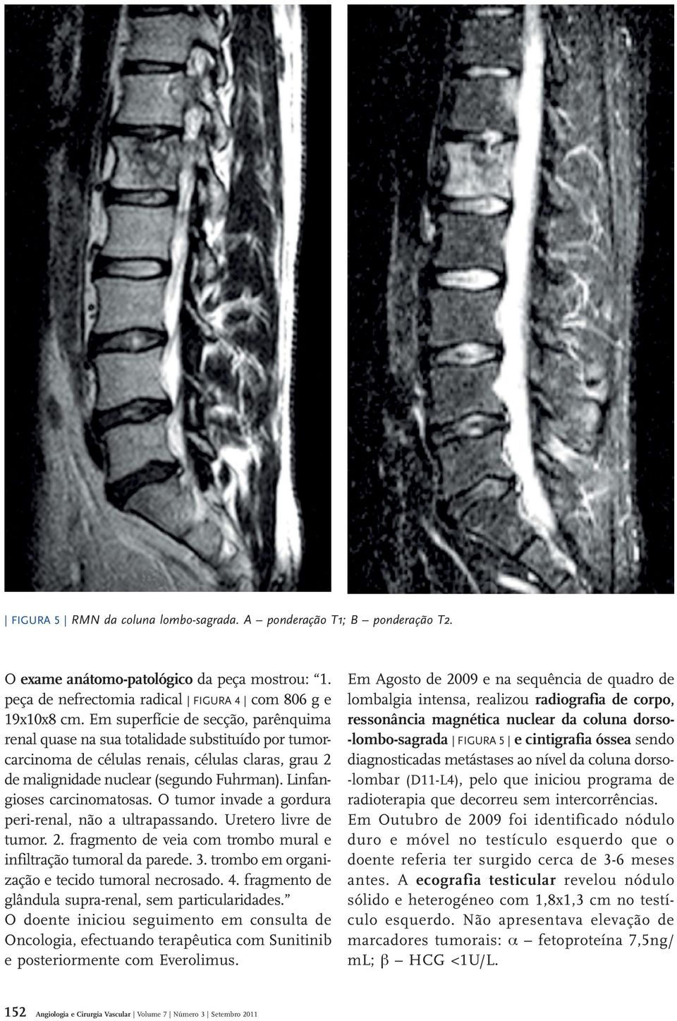 Linfangioses carcinomatosas. O tumor invade a gordura peri renal, não a ultrapassando. Uretero livre de tumor. 2. fragmento de veia com trombo mural e infiltração tumoral da parede. 3.