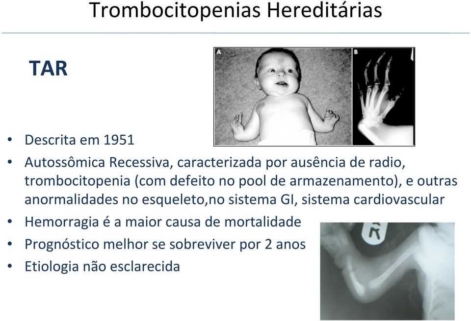 anormalidades no esqueleto,no sistema GI, sistema cardiovascular Hemorragia é a maior